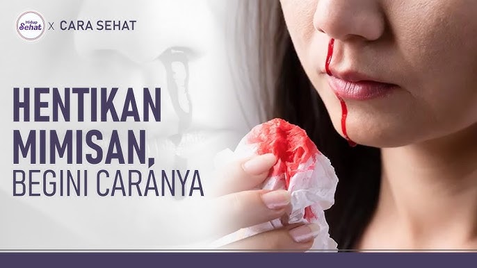 Cara Mengatasi Mimisan dengan Cepat dan Aman di Rumah
